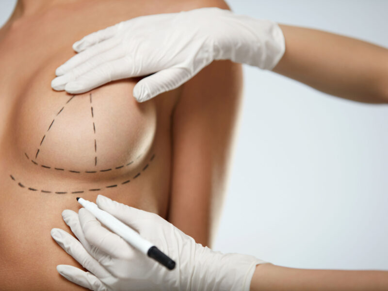 Dra. Ana Karina- plástica em santos-implantes mamários